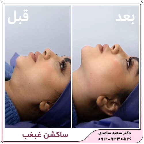 نمونه کار ساکشن غبغب