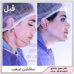 ساکشن غبغب