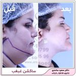 ساکشن غبغب