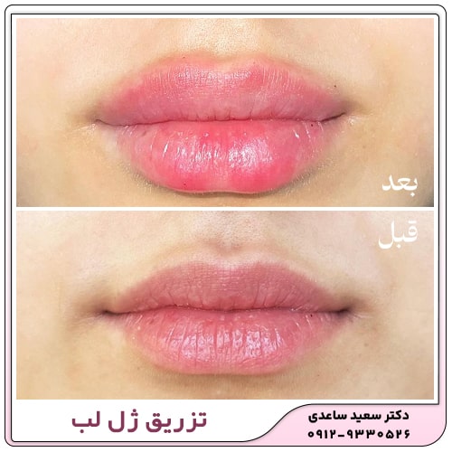 نمونه کار تزریق ژل لب