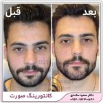 زاویه سازی فک و صورت