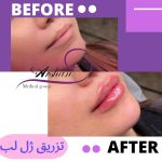 تزریق ژل لب