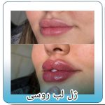 تزریق ژل لب