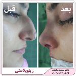 رینوپلاستی یا عمل زیبایی بینی