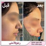 رینوپلاستی یا عمل زیبایی بینی