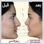 رینوپلاستی یا عمل زیبایی بینی