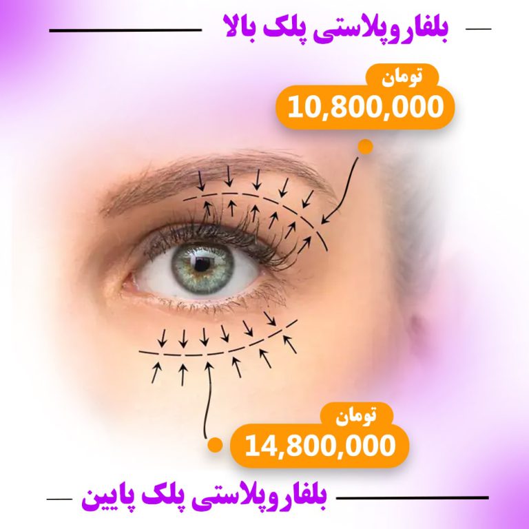 بنر تخفیف بلفاروپلاستی
