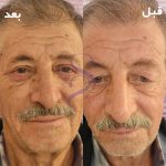 بلفاروپلاستی