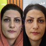 بلفاروپلاستی