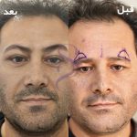 بلفاروپلاستی
