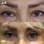 بلفاروپلاستی