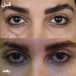 بلفاروپلاستی