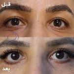 بلفاروپلاستی