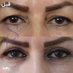 بلفاروپلاستی