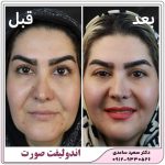 اندولیفت
