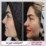 اندولیفت