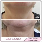 اندولیفت