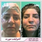 اندولیفت