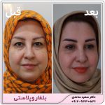 بلفاروپلاستی