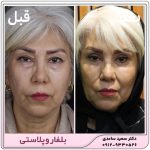 بلفاروپلاستی