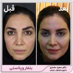 بلفاروپلاستی