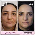 بلفاروپلاستی