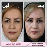 بلفاروپلاستی