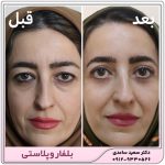 بلفاروپلاستی