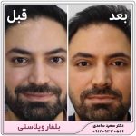 بلفاروپلاستی