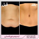 ابدومینوپلاستی
