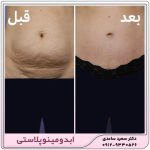 ابدومینوپلاستی