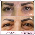 بلفاروپلاستی
