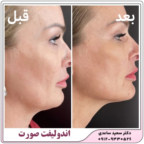 نمونه کار اندولیفت