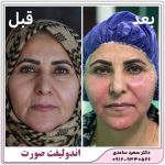 اندولیفت