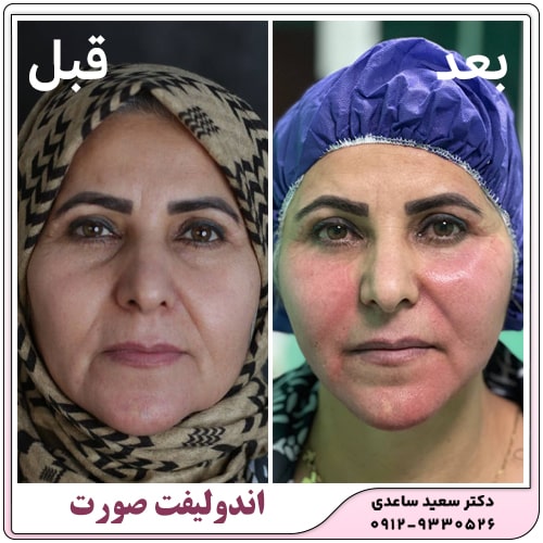 نمونه کار اندولیفت
