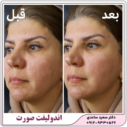 نمونه کار اندولیفت