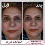 اندولیفت