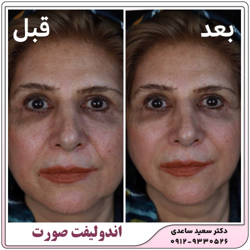 نمونه کار اندولیفت