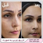 تزریق چربی به صورت