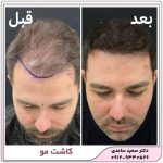 کاشت مو