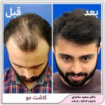 کاشت مو