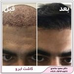 کاشت مو
