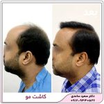 کاشت مو