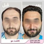 کاشت مو