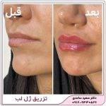 تزریق ژل لب