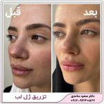 تزریق ژل لب