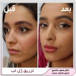 تزریق ژل لب