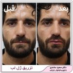 تزریق ژل لب
