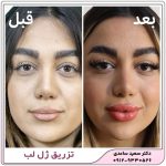 تزریق ژل لب