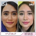 تزریق ژل لب